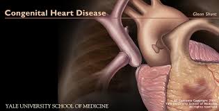 Congenital Heart Disease