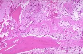 Healing fracture