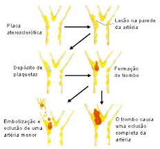 http://www.saudeemmovimento.com.br/profissionais/pesquisa/patologia/avc/imagens/avc_trombose.jpg
