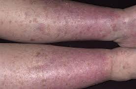 Stasis Dermatitis