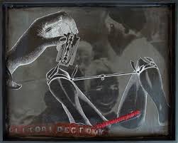 clitoridectomy