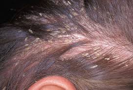 http://www.dicaspraticas.com.br/images/articles/Pele-seborrheic_dermatitis2.jpg