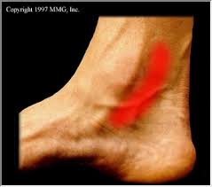 Tarsal Tunnel Syndrome: Due to