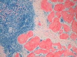 http://upload.wikimedia.org/wikipedia/commons/1/19/Amyloidosis,_Node,_Congo_Red.jpg