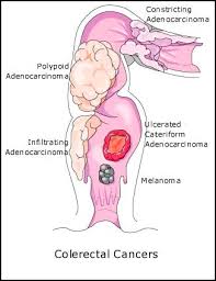 In colorectal cancer