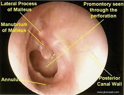 http://www.ghorayeb.com/files/TYMPANIC_PERFORATION_LEFT_LABELED.jpg