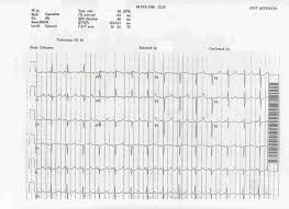 http://askdrwiki.com/mediawiki/images/thumb/2/2a/Prolonged_QT.jpg/750px-Prolonged_QT.jpg