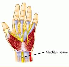 carpal tunnel syndrome pain and 