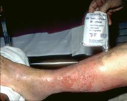 Stasis dermatitis