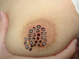 Breast Rash