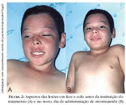 http://www.scielo.br/img/revistas/abd/v81n5/v81n5a09f02.jpg