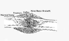More on bone healing soon