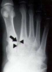  of the Lisfranc joint.