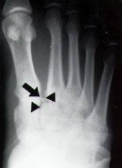 of the Lisfranc joint.