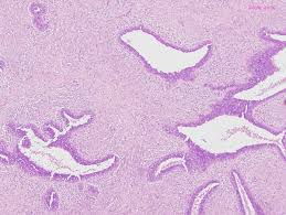 http://www.breastpathology.info/Images/Benign/Fibroadenoma/juvenilea.jpg