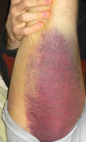 a bit of internal bleeding