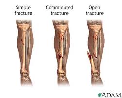 one in which the fractured bone