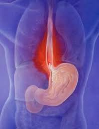 Acid Reflux Acid reflux may worsen