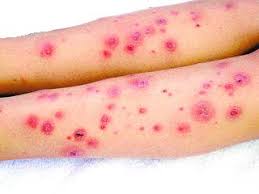 Mycobacterial_skin_sores
