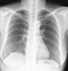 interstitial lung disease.