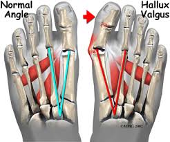 Bunions eOrthopod com