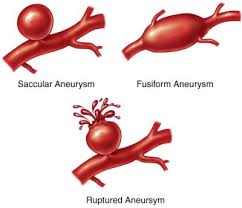 aneurysm pronunciation