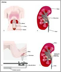 ureter become very painful B