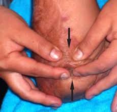 http://www.efisioterapia.net/articulos/graficos/certamen2007/34_clip_image044.jpg