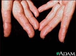 http://www.mdconsult.com/das/patient/body/0/0/10041/1966_en.jpg