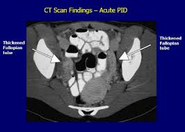 Fig.3 CT scan imagine of