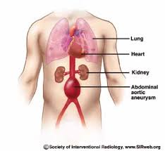 http://aaadoctor.org/images/patients/SIR_AAA_aneurysm_2.jpg