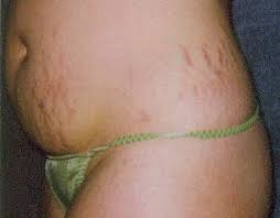 Stretch Mark Repair Cream 4oz by