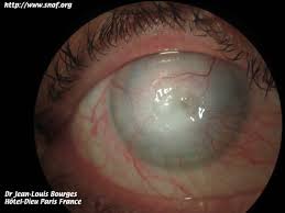 http://www.snof.org/maladies/imagesmaladie/amibe_perforation.jpg