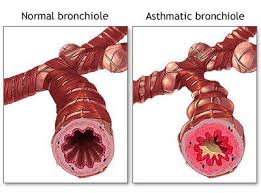 asthma-linked