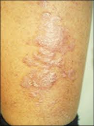 Stasis Dermatitis is