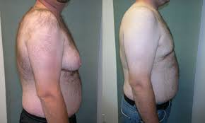 http://upload.wikimedia.org/wikipedia/commons/d/dc/Severe_Gynecomastia.jpg