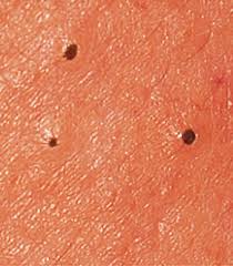 Home Remedies for Blackheads