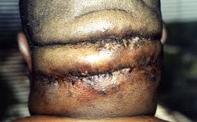 http://www.blackhairmedicalexpert.com/images/Advanced-Acne_Keloidalis_Nuchae_1-Immediate-PostOp.jpg
