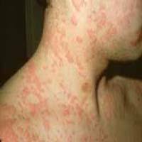 http://www.globalpinoy.com/images/pinoyhealth/FirstAid/anaphylaxis.jpg