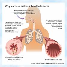 asthma
