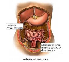 Blockages can occur at any point