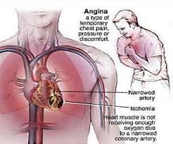 http://www.h4heart.com/h4heart/images/Article_Images/Angina-_part_1.jpg