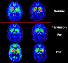 http://upload.wikimedia.org/wikipedia/commons/8/87/PET_scan_Parkinson%27s_Disease.jpg