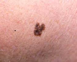 http://diagnosethis.ca/wp-content/uploads/2009/07/melanoma-fig3.jpg