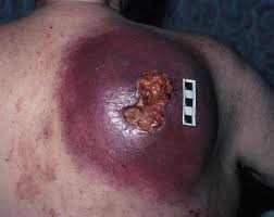 http://www.worldwidewounds.com/2002/march/Naylor/images/Fig-1-Melanoma-Back.jpg