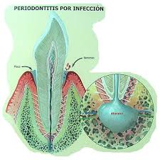 http://www.clinicacid.com/pic/periodoncia/periodontitis.jpg